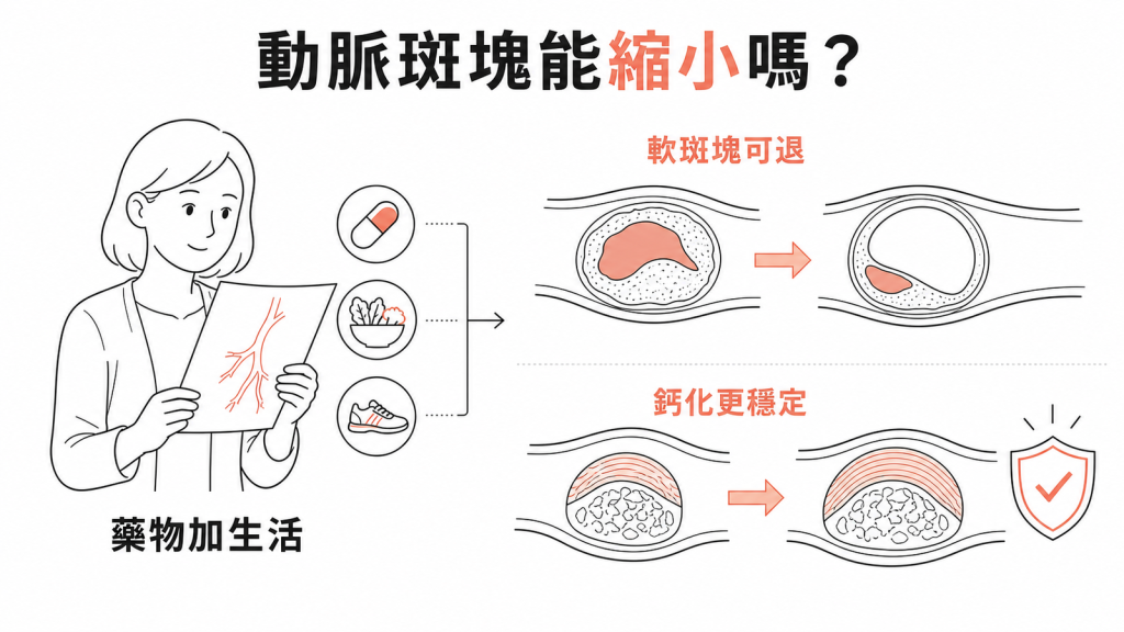 動脈斑塊資訊圖:軟斑塊可退、鈣化更穩定,藥物加生活調整
