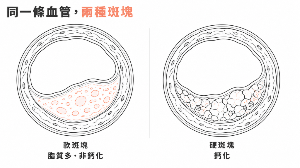 同一條血管裡的軟斑塊與硬斑塊剖面對照