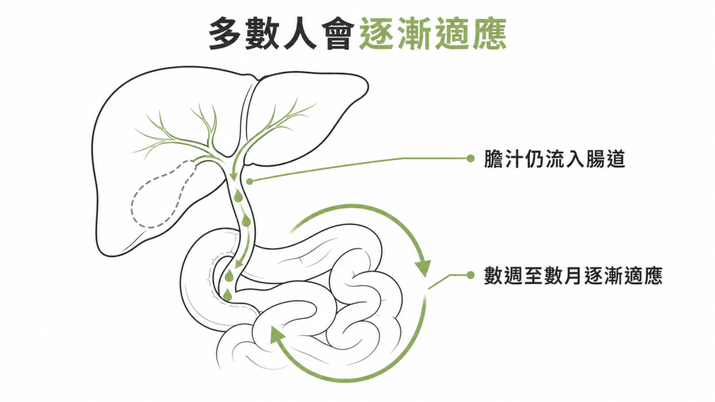 多數人在膽囊切除後數週至數月逐漸適應、膽汁仍持續流入腸道的示意圖