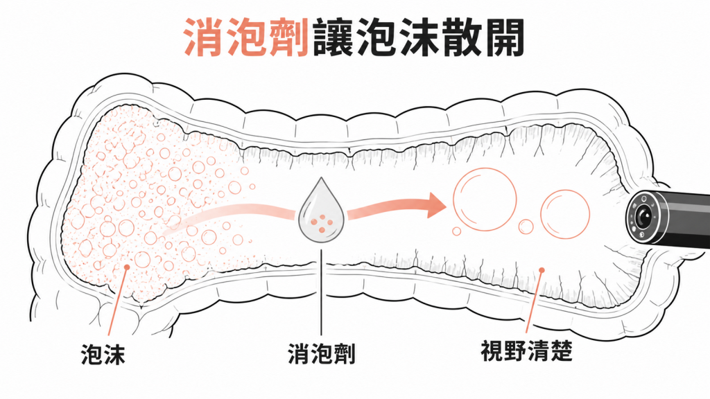Simethicone消泡劑讓腸道泡沫聚合減少,使大腸鏡視野更清楚