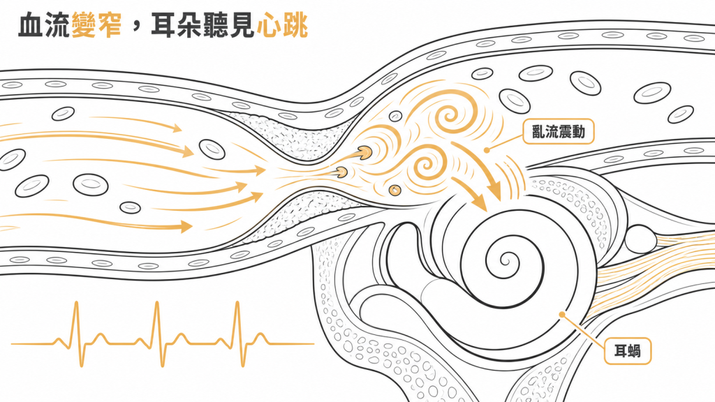 血管變窄造成亂流,震動傳到旁邊的耳蝸,形成跟著心跳的耳鳴