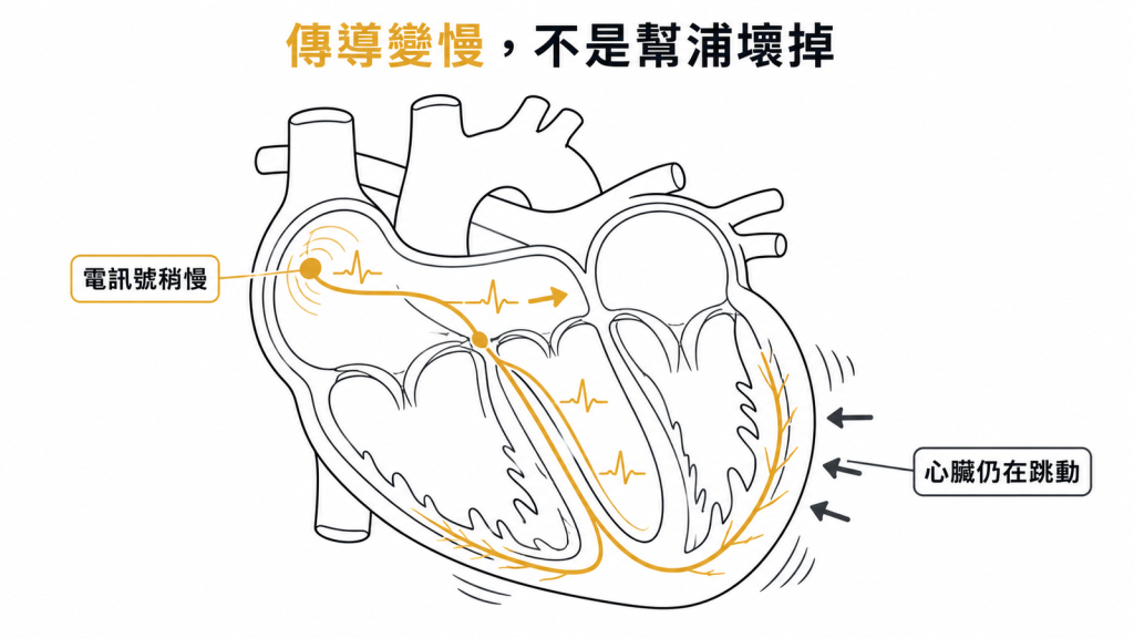 傳導變慢與心臟幫浦功能仍正常之間差別的示意圖