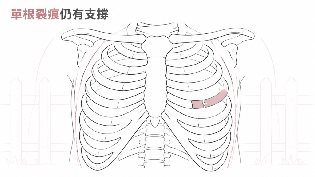 肋骨像護欄單點裂痕仍由胸壁支撐的圖解