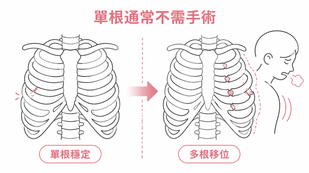 單根穩定骨折與多根移位才進入手術評估的圖解