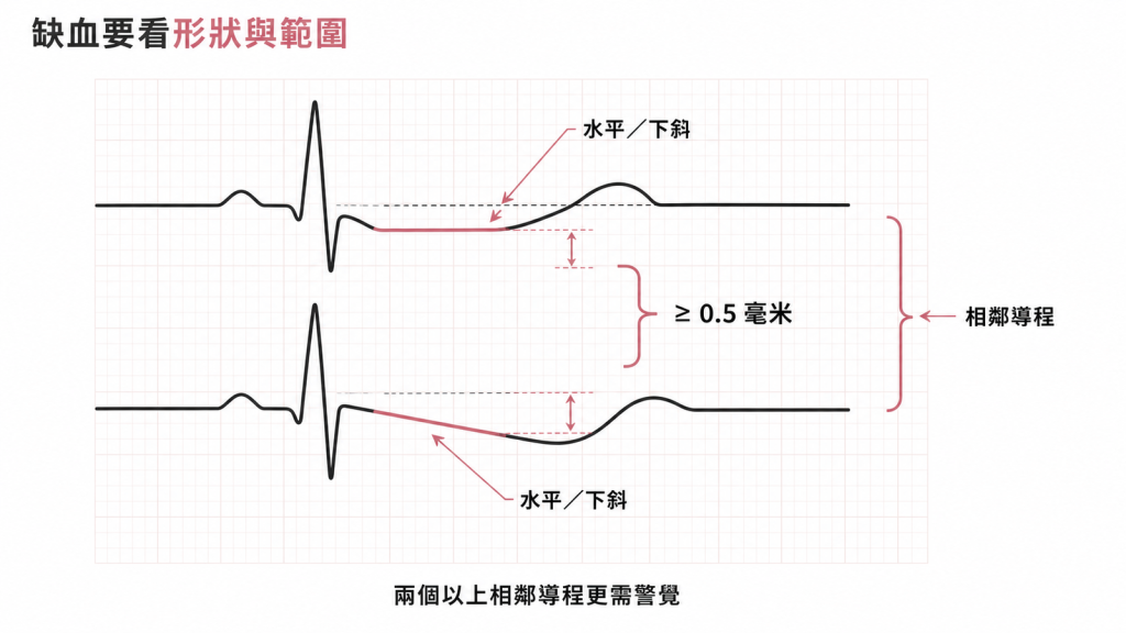 缺血型 ST 段下降要看形狀與範圍:水平或下斜達 0.5 毫米、跨兩個相鄰導程的示意圖