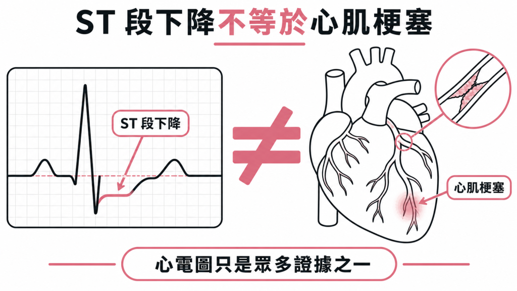 ST 段下降不等於心肌梗塞,心電圖只是眾多證據之一的示意圖