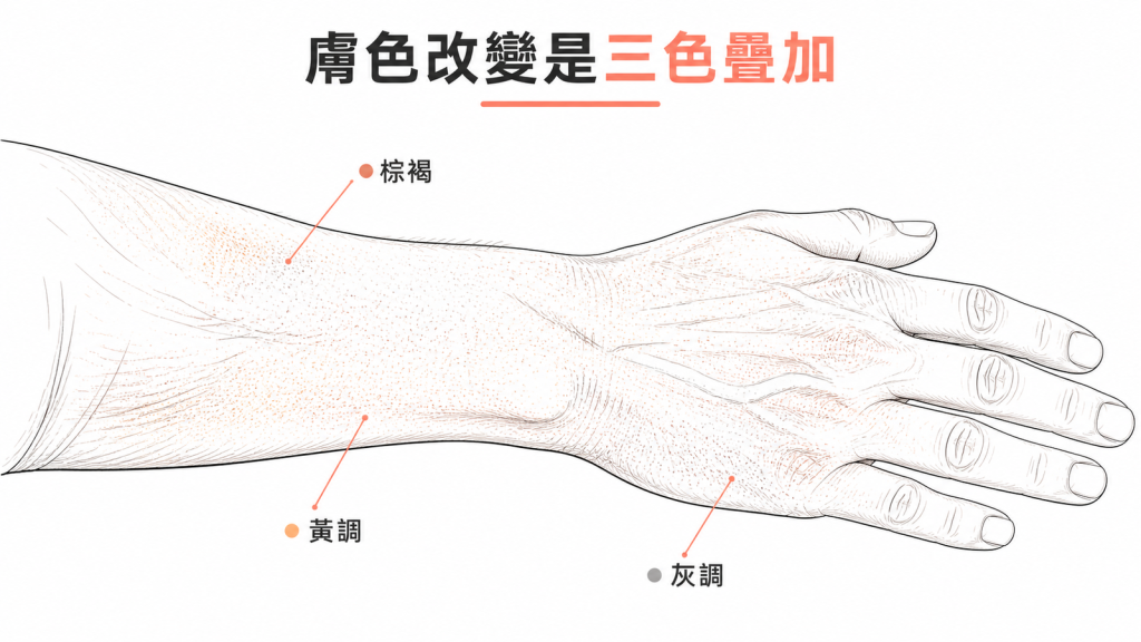 膚色改變三色疊加示意:黑色素的棕褐、滯留色素的黃調、含鐵血黃素的灰調