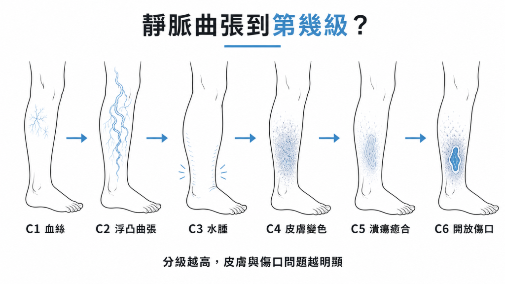 靜脈曲張 CEAP 分級從 C1 血絲到 C6 開放性傷口