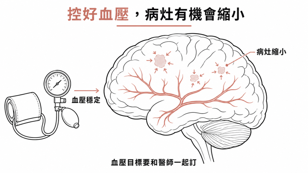 控制好血壓後白質病灶有機會縮小,血壓目標要與醫師一起訂