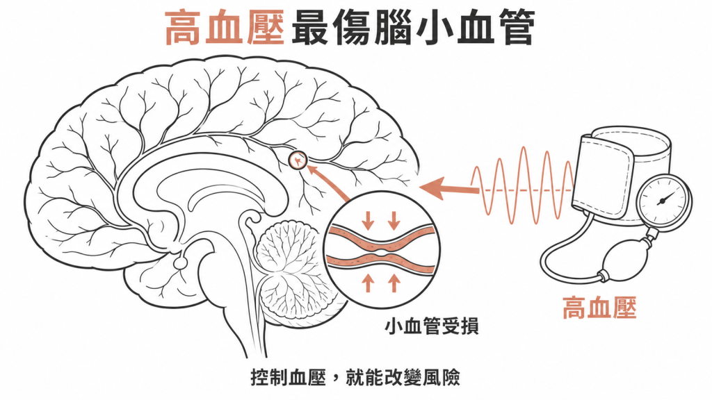 高血壓是白質高訊號最主要且可改變的驅動因素,會傷害腦部小血管