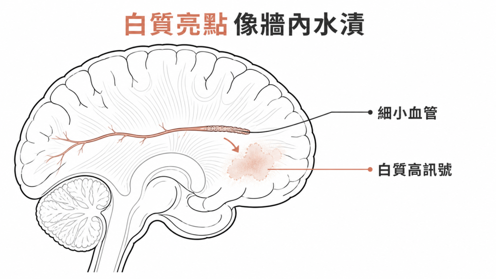腦部細小血管老化,白質出現像牆內水漬般的高訊號亮點