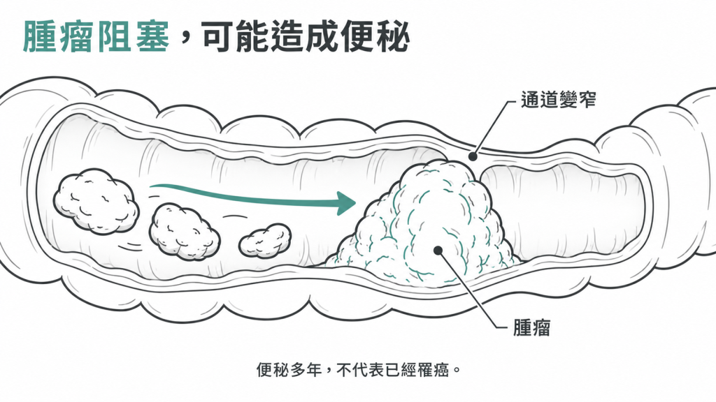 腫瘤長在腸道裡把通道擋窄，便秘可能是它的第一個症狀；反過來說便秘多年不代表已經罹癌