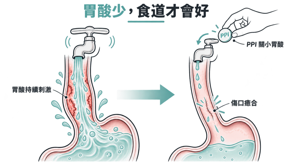 左邊水龍頭大開、熱水不斷沖著食道傷口,右邊水龍頭被關小、傷口開始結痂癒合的對照示意圖