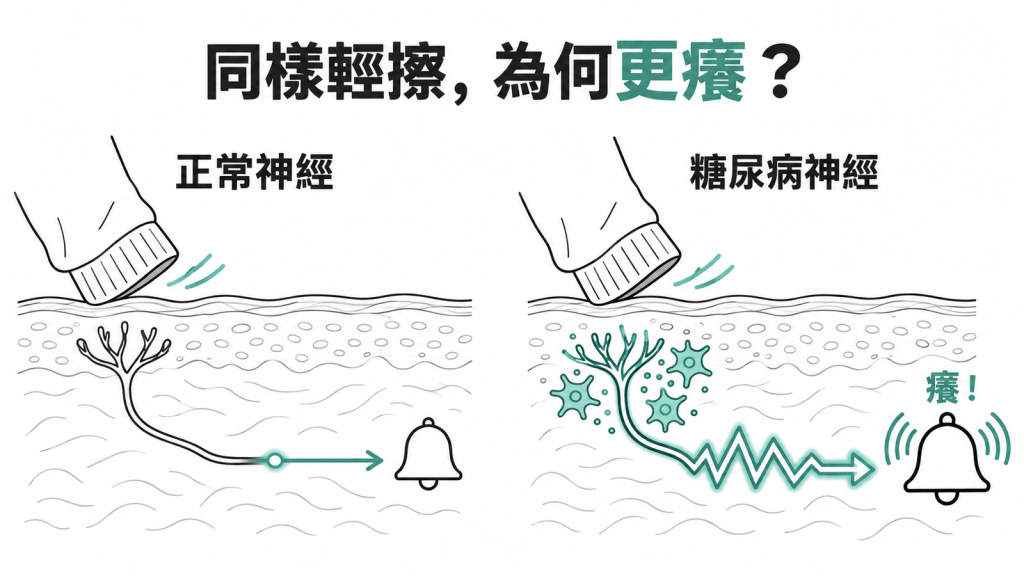 保全警報器被輕微摩擦觸發大響,比喻糖尿病神經膠細胞釋放發炎物質、讓癢覺路徑過度敏感的示意圖