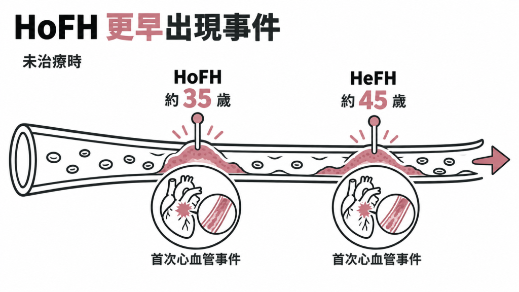 發病年紀:45 歲對上 35 歲:沒有治療時,異型合子 HeFH 第一次心肌梗塞或中風等心血管事件通常在 45 歲左右;同型合子 Ho