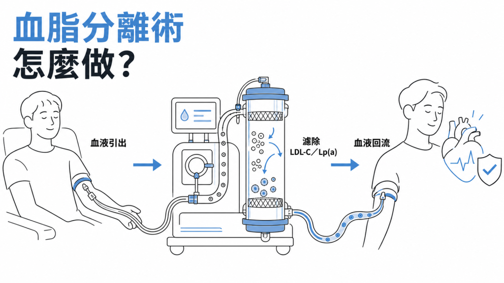 血脂分離術流程圖:血液從手臂引出、經濾器濾除 LDL-C 與 Lp(a),乾淨的血再回流體內