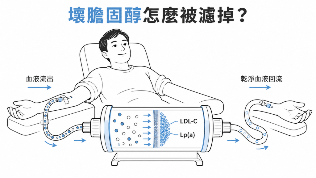 血脂分離術原理示意:血液從手臂流出,經濾器攔下 LDL-C 與 Lp(a),乾淨的血再回流體內