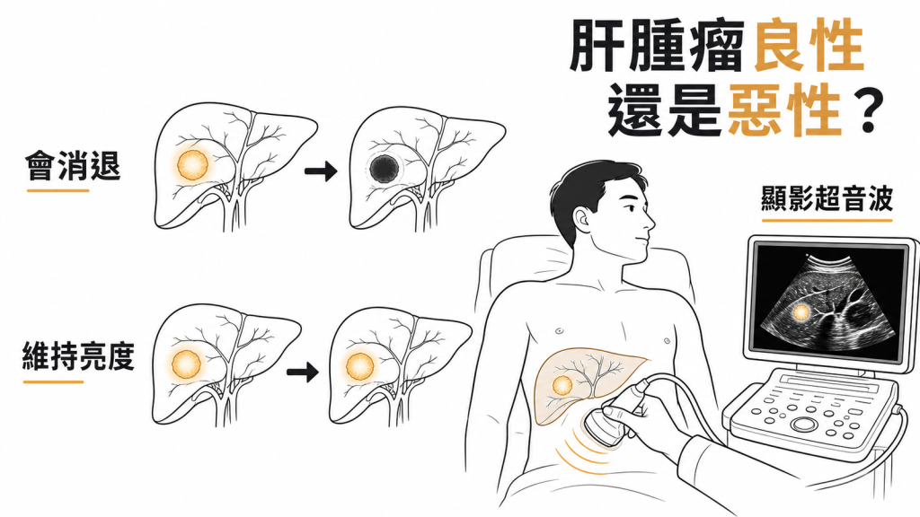 超音波判斷肝臟腫瘤良性惡性的對照圖：打顯影劑後會消退傾向惡性，維持亮度傾向良性