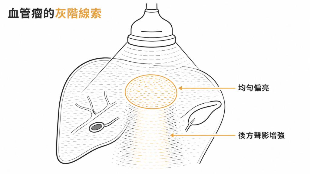 血管瘤在黑白超音波上的兩個線索：整顆均勻偏亮，病灶後方也跟著變亮