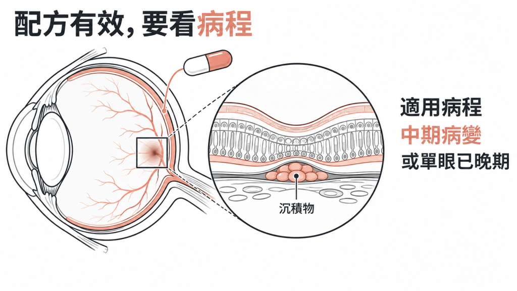 AREDS2 配方的適用病程：眼底已出現中期病變的沉積物，或單眼已進展到晚期黃斑部病變