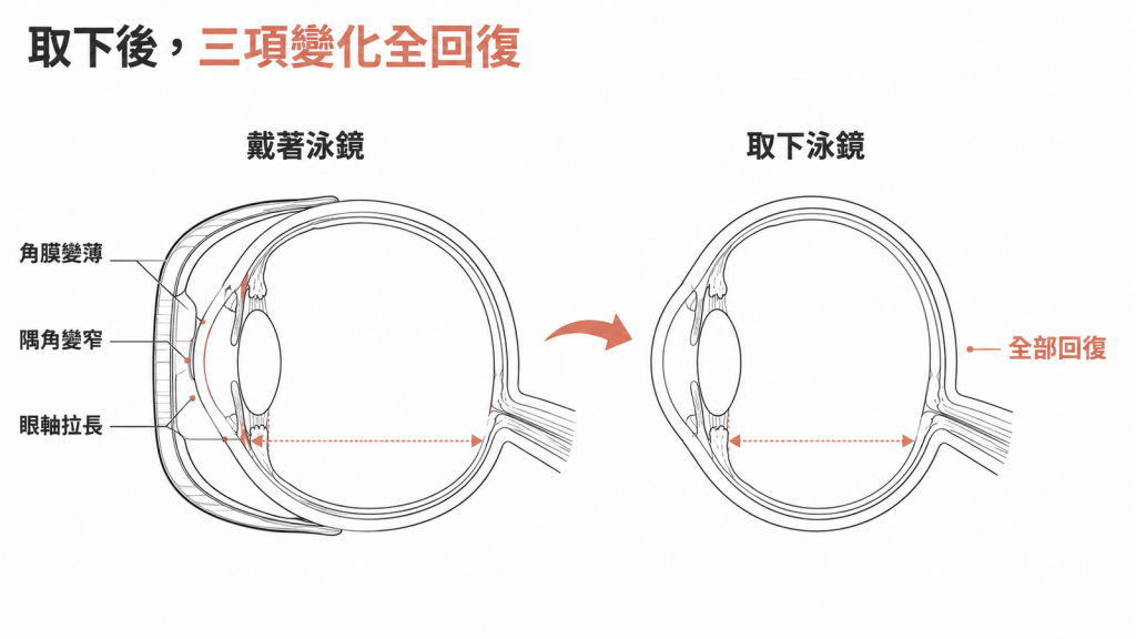 戴著泳鏡時角膜變薄、隅角變窄、眼軸拉長,取下泳鏡後三項變化全部回復的對照示意圖