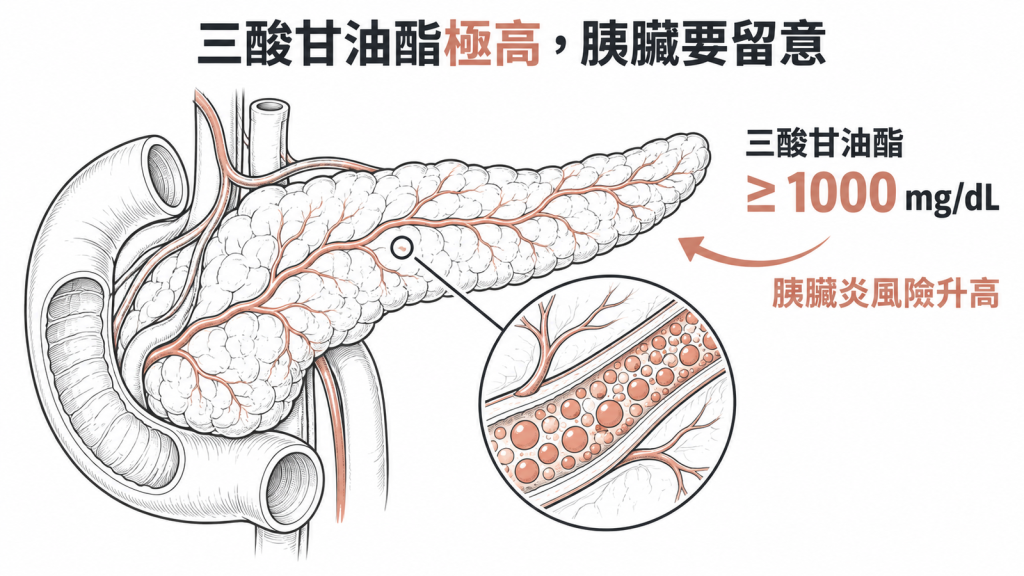 三酸甘油酯達到 1000 mg/dL 以上時胰臟炎風險才明顯升高，多數健檢紅字離這個門檻很遠