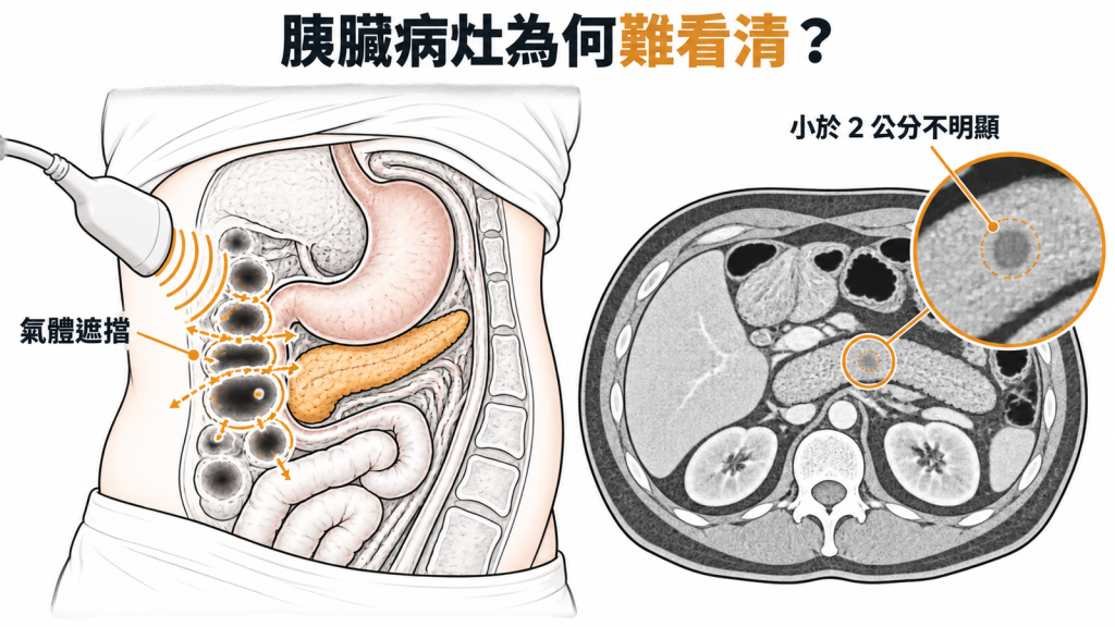 胰臟位置深,超音波易受腸氣干擾,電腦斷層上小腫瘤不易分辨