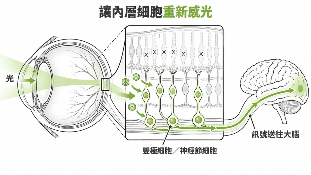視網膜分層示意圖:外層感光細胞已流失,AAV 把感光蛋白送進內層細胞,訊號經視神經傳到大腦