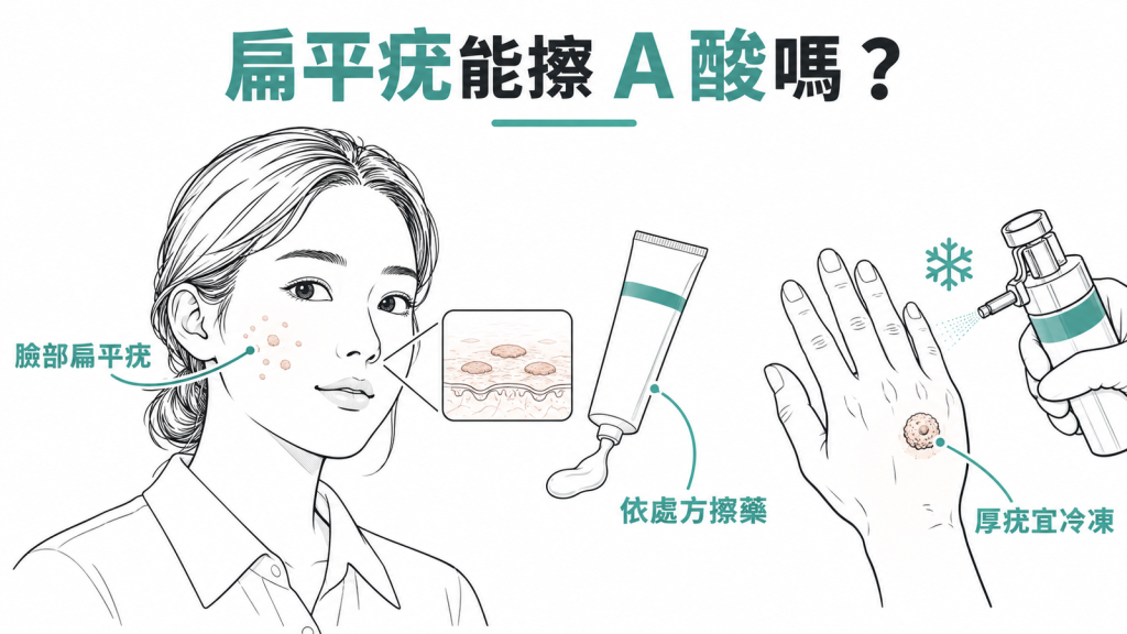扁平疣能擦 A 酸嗎：臉部扁平疣依處方擦 A 酸，手上的厚疣以冷凍治療為主