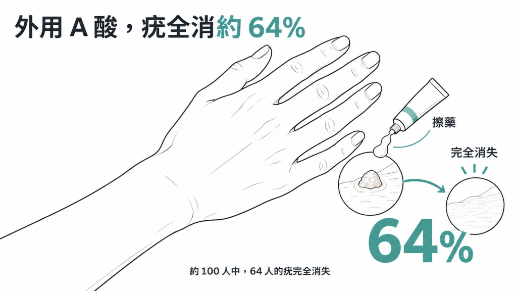 統合分析中擦外用 A 酸的 100 人約 64 人疣完全消失，約 6 人復發